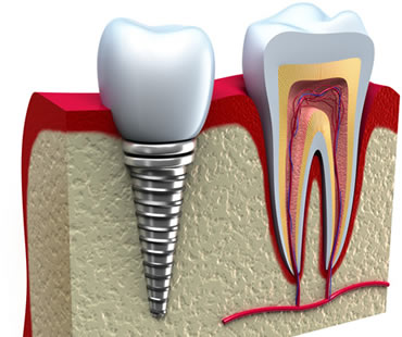 dental implants dentist in Longview