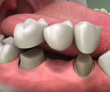 Dental crowns