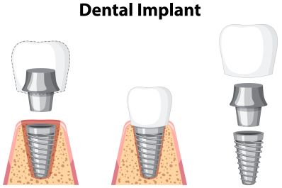 Mini Dental Implants: When They're Right for You