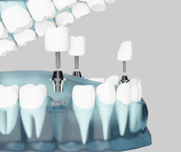 Dental Implants: Choosing the Best Implant Dentist in Longview